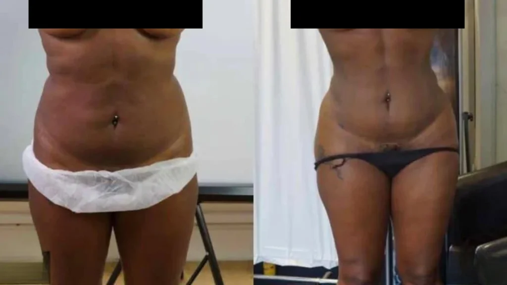 Abdomen 360 Liposuction