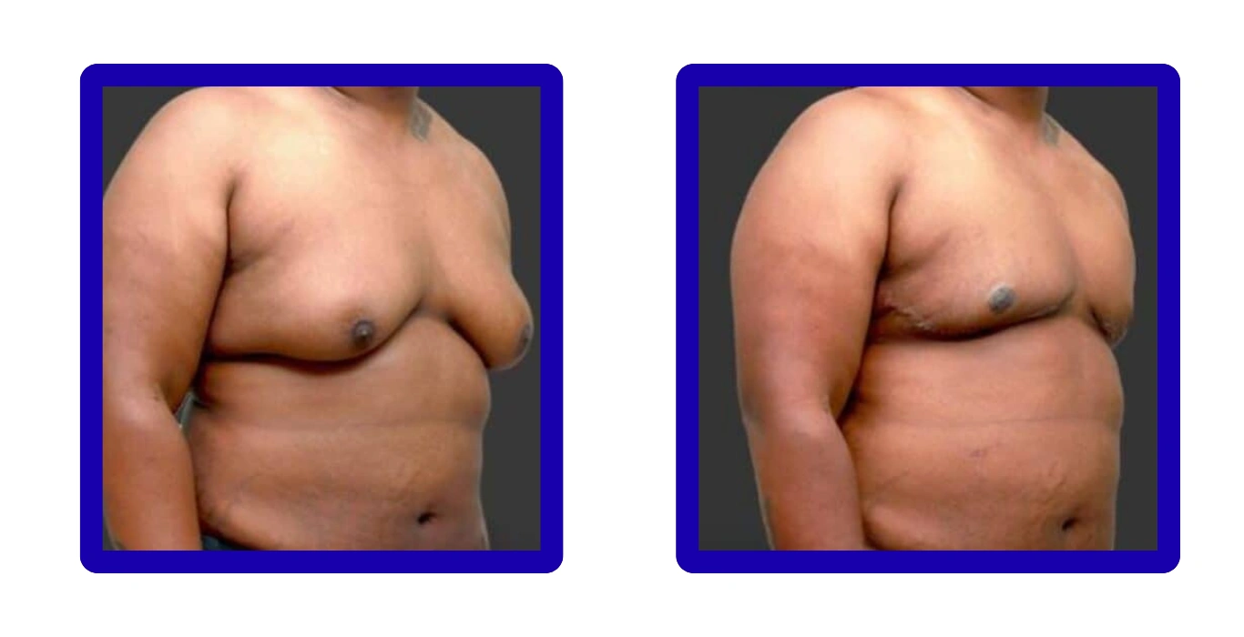 grade 4 gynecomastia